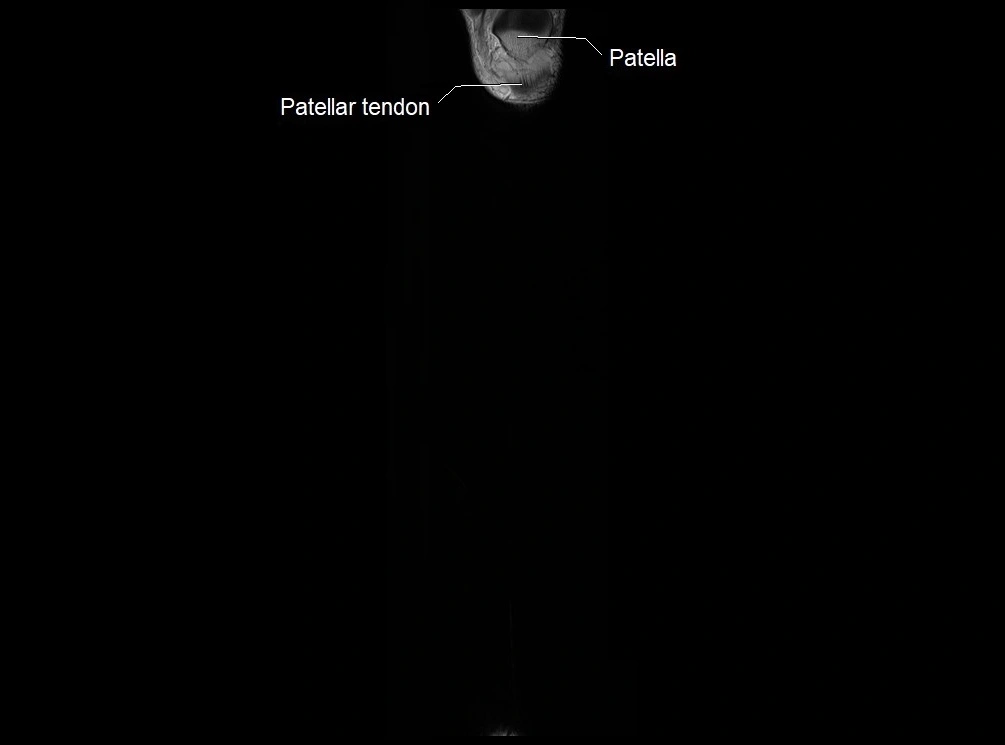 MRI 3T leg (tibia & fibula) labelled coronal cross sectional anatomy image 2.webp